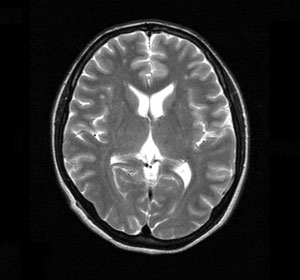 頭部MRI(断層撮影)