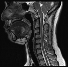 頚部MRI